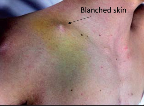 Management of Displaced Midshaft Clavicle Fractures in Pediatrics and Adolescents: Operative vs Nonoperative Treatment.