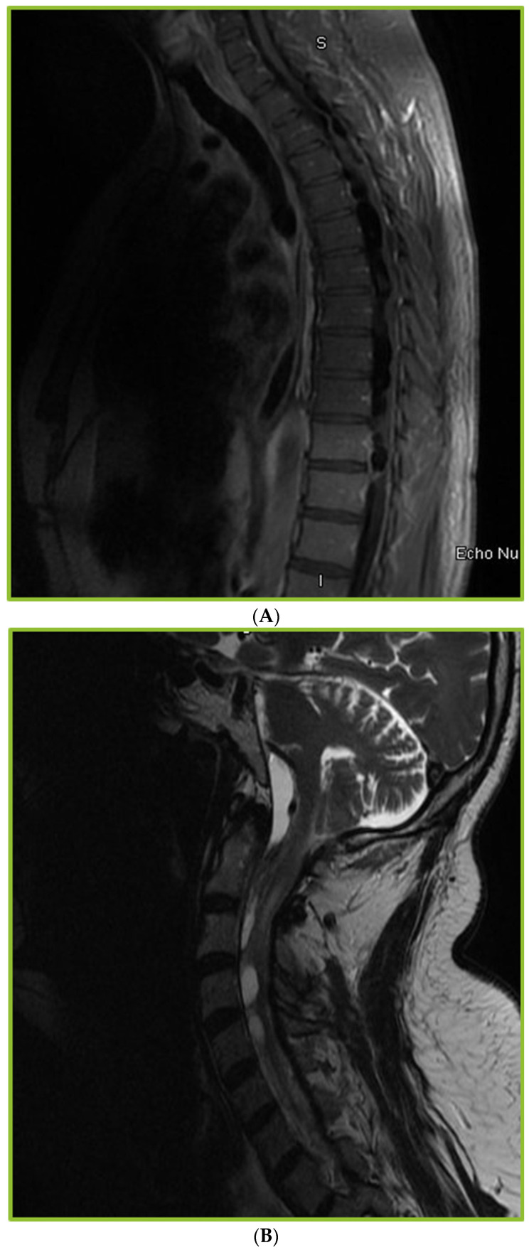 Spinal Arachnoiditis in Patients with Coccidioidomycosis Meningitis-Analysis of Clinical and Imaging Features.