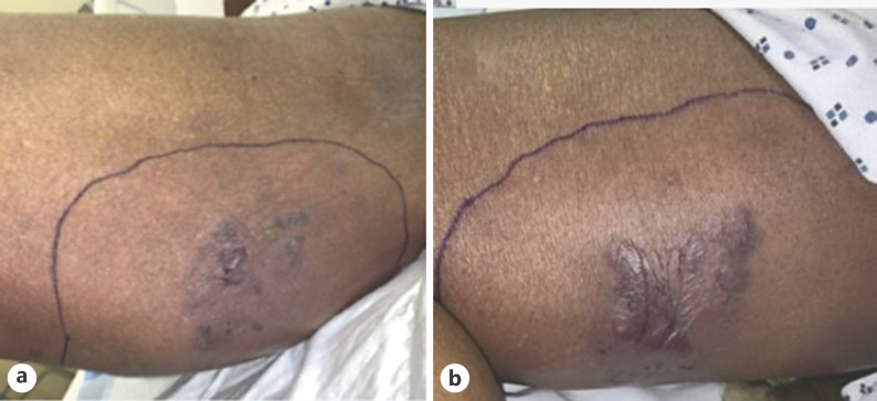 A Case of Acute Myeloid Leukemia-Associated Necrotizing Sweet Syndrome.