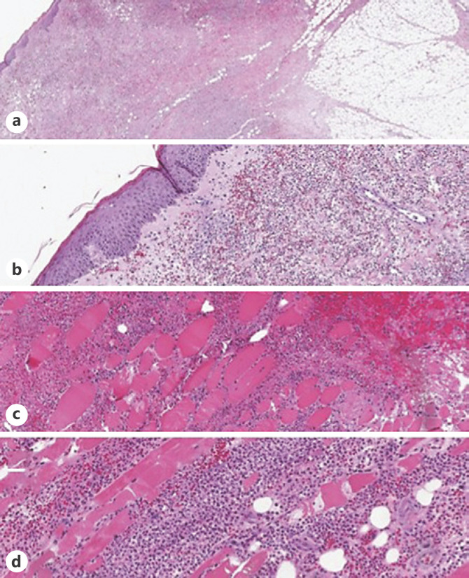 A Case of Acute Myeloid Leukemia-Associated Necrotizing Sweet Syndrome.