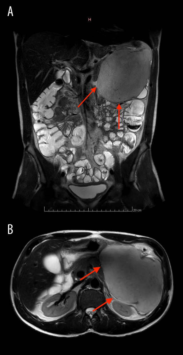 Large Desmoid Tumor of the Pancreas: A Report of a Rare Case and Review of the Literature.