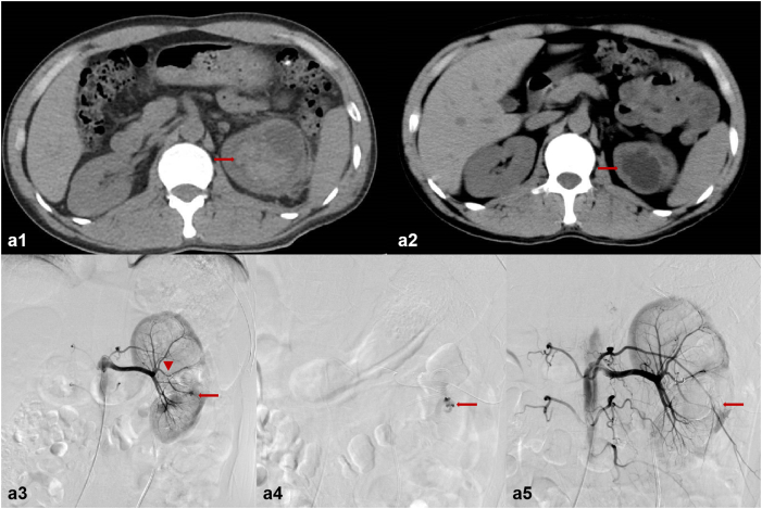 Percutaneous transcatheter super-selective renal arterial embolization with N-butyl cyanoacrylate for iatrogenic renal hemorrhage