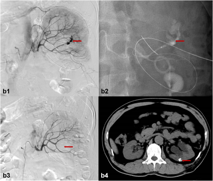 Percutaneous transcatheter super-selective renal arterial embolization with N-butyl cyanoacrylate for iatrogenic renal hemorrhage