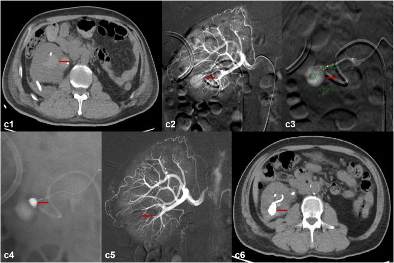 Percutaneous transcatheter super-selective renal arterial embolization with N-butyl cyanoacrylate for iatrogenic renal hemorrhage