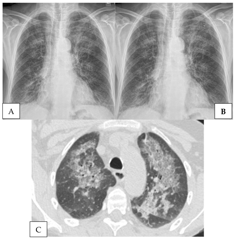 The Pathogenesis and Diagnosis of <i>Pneumocystis jiroveci</i> Pneumonia.