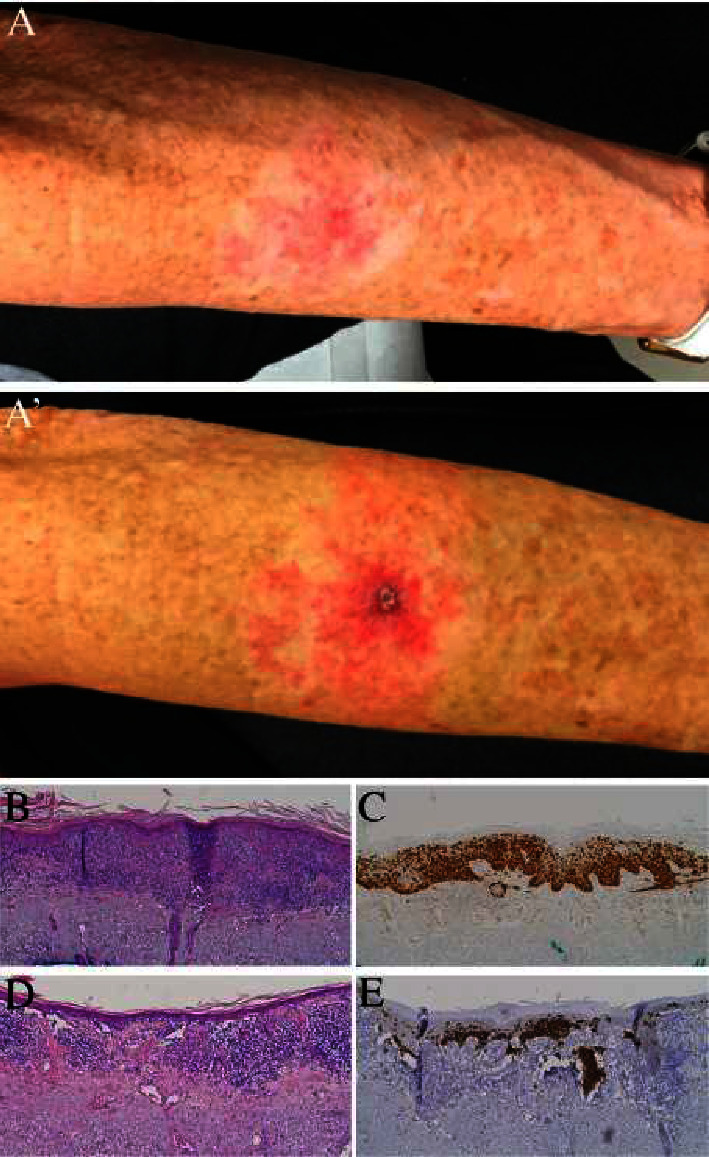 Amelanotic Melanoma Treated as Fungal Infection for Years.