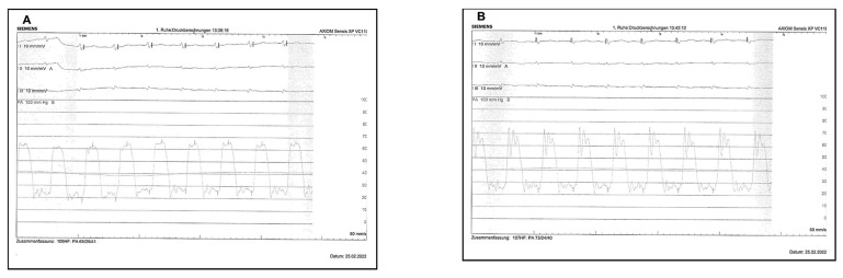 Using a Fibrinolysis Delivery Catheter in Pulmonary Embolism Treatment for Measurement of Pulmonary Artery Hemodynamics.