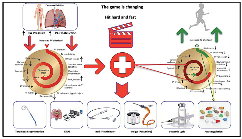 Using a Fibrinolysis Delivery Catheter in Pulmonary Embolism Treatment for Measurement of Pulmonary Artery Hemodynamics.