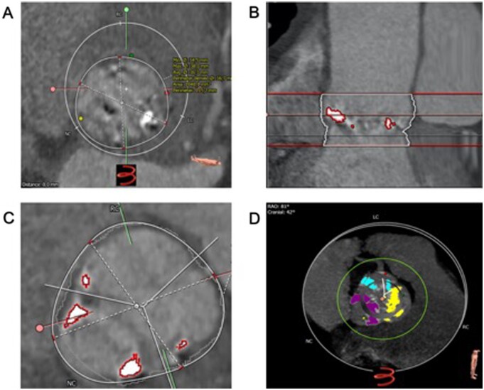 Different calcification patterns of tricuspid and bicuspid aortic valves and their clinical impact.