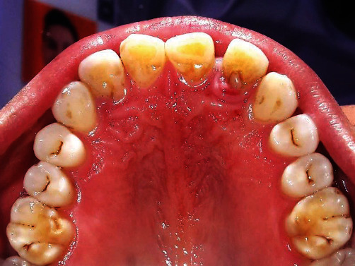 Combined Periodontal and Endodontic Management of Palatal Radicular Groove with Platelet-Rich Fibrin and Biodentine®.
