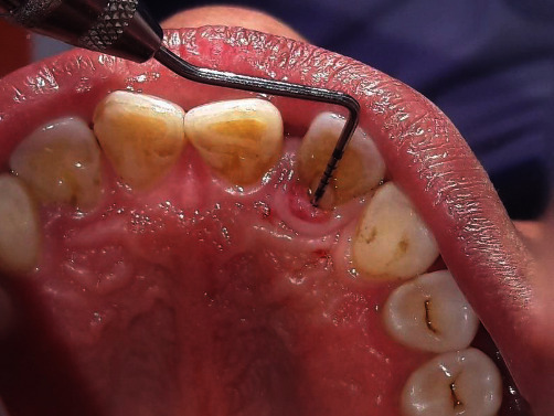 Combined Periodontal and Endodontic Management of Palatal Radicular Groove with Platelet-Rich Fibrin and Biodentine®.