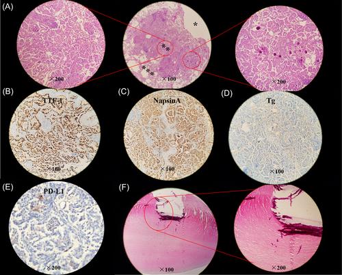 Lung adenocarcinoma associated with cystic airspaces