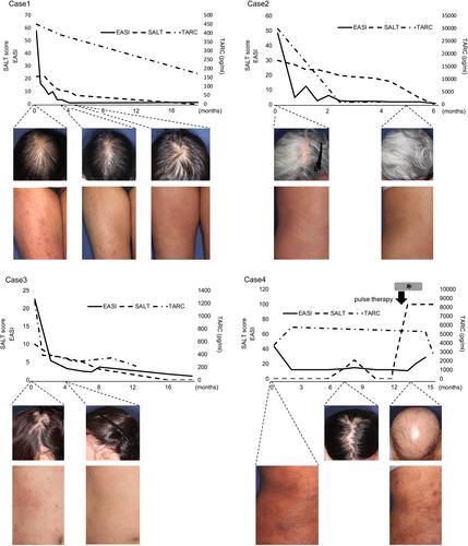 Two-sided influence of dupilumab on alopecia areata co-existing with severe atopic dermatitis: A case series and literature review