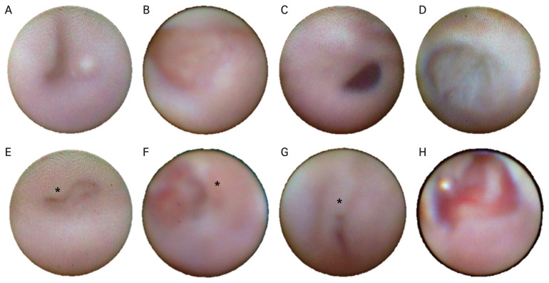 Dacryoendoscopic Findings of Patients with Lacrimal Drainage Obstruction Associated with Cancer Treatment.