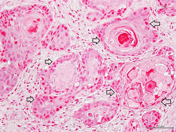 Trichoblastomas derived from the facial skin with tactile hair in aged house musk shrews (Suncus murinus).