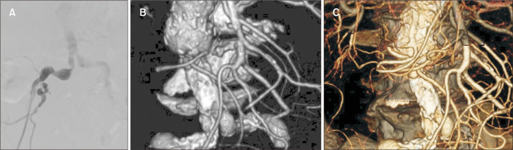 Bilateral Iliac Endobypass Solution in Iliac Artery Rupture during TEVAR Procedure: A Case Report and Review of the Literature.