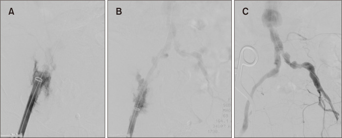 Bilateral Iliac Endobypass Solution in Iliac Artery Rupture during TEVAR Procedure: A Case Report and Review of the Literature.