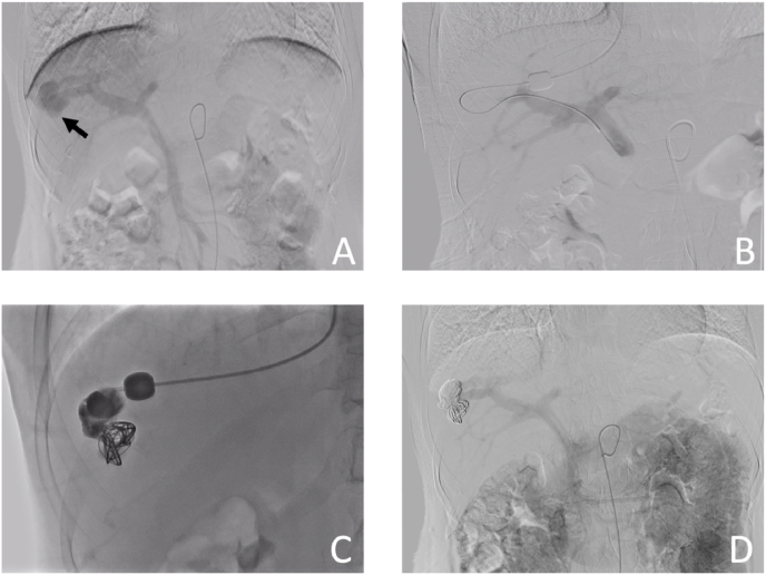 Balloon-occluded retrograde transvenous obliteration for treatment of congenital intrahepatic portosystemic venous shunt: A case report