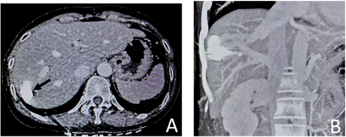 Balloon-occluded retrograde transvenous obliteration for treatment of congenital intrahepatic portosystemic venous shunt: A case report