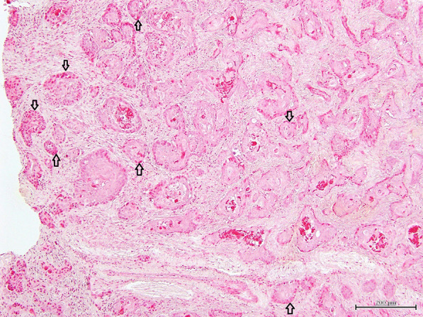 Trichoblastomas derived from the facial skin with tactile hair in aged house musk shrews (Suncus murinus).