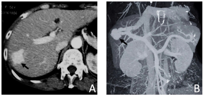 Balloon-occluded retrograde transvenous obliteration for treatment of congenital intrahepatic portosystemic venous shunt: A case report