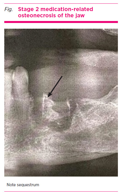 Osteonecrosis of the jaw and denosumab.