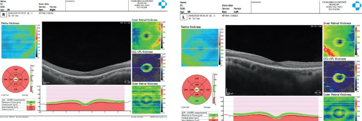 Optical Coherence Tomography (OCT) Diagnostic of Retinitis Pigmentosa - Case Study.