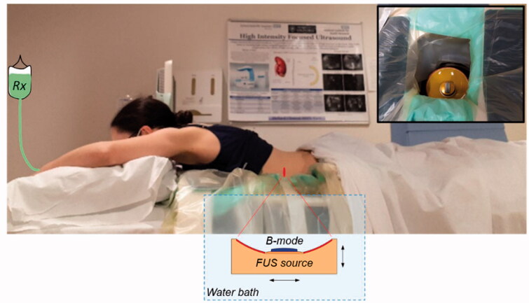 Effects of human tissue acoustic properties, abdominal wall shape, and respiratory motion on ultrasound-mediated hyperthermia for targeted drug delivery to pancreatic tumors.