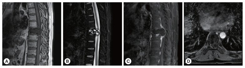 Imaging Manifestations and Misdiagnosis Analysis of Six Cases of Bone Hydatid Disease.