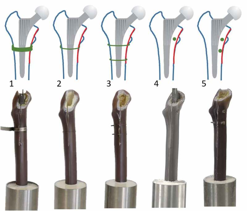 Biomechanical testing of different fixation techniques for intraoperative proximal femur fractures: a technical note.