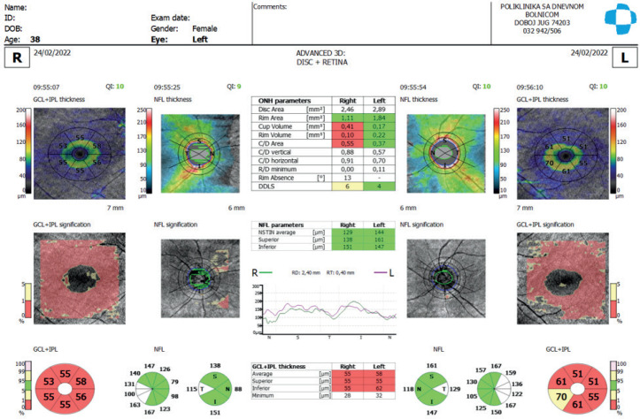 Optical Coherence Tomography (OCT) Diagnostic of Retinitis Pigmentosa - Case Study.