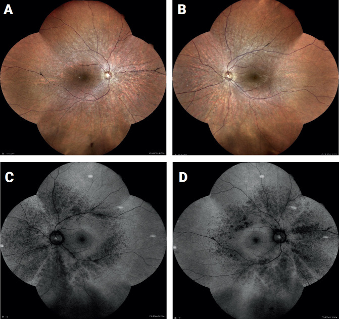 Optical Coherence Tomography (OCT) Diagnostic of Retinitis Pigmentosa - Case Study.