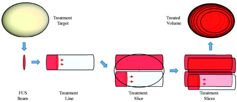 Effects of human tissue acoustic properties, abdominal wall shape, and respiratory motion on ultrasound-mediated hyperthermia for targeted drug delivery to pancreatic tumors.