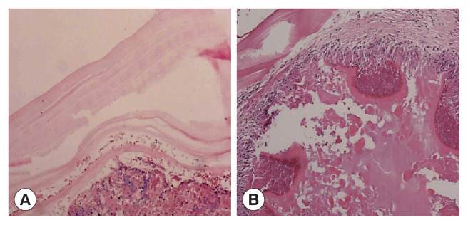 Imaging Manifestations and Misdiagnosis Analysis of Six Cases of Bone Hydatid Disease.