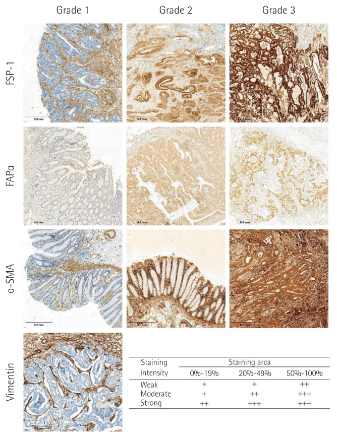 FSP-1 expression in cancer cells is relevant to long-term oncological outcomes in nonmetastatic colorectal cancer.