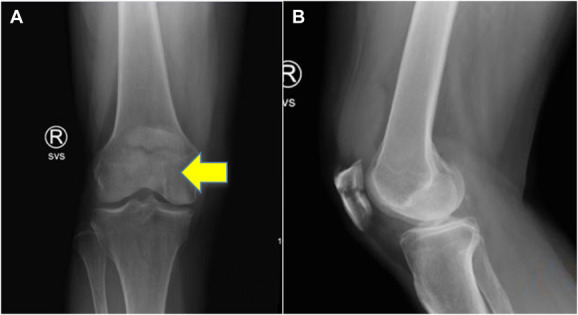 Adjunct neutralization plating in patella fracture fixation: a technical trick.