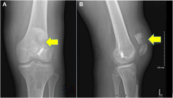 Adjunct neutralization plating in patella fracture fixation: a technical trick.