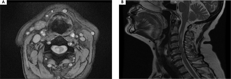 Cervical myelitis due to herpes zoster: case report.