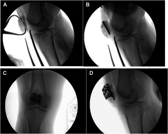 Adjunct neutralization plating in patella fracture fixation: a technical trick.