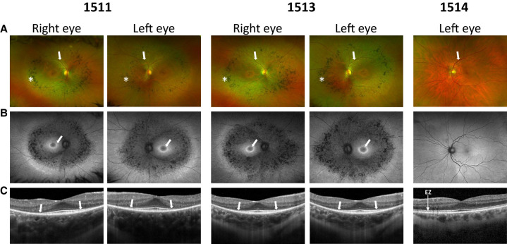 Identification of a novel large multigene deletion and a frameshift indel in <i>PDE6B</i> as the underlying cause of early-onset recessive rod-cone degeneration.