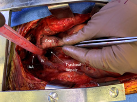 Aortic arch replacement and autologous pericardial tracheal patch for an aorto-tracheal fistula.