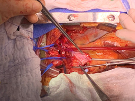 Aortic arch replacement and autologous pericardial tracheal patch for an aorto-tracheal fistula.