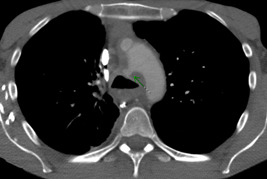 Aortic arch replacement and autologous pericardial tracheal patch for an aorto-tracheal fistula.