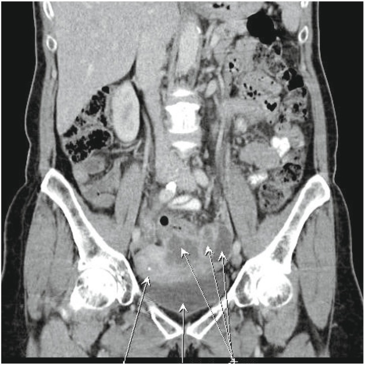 A Large Adnexal Tumor Caused by <i>Enterobius Vermicularis</i> Mimicking Malignancy.