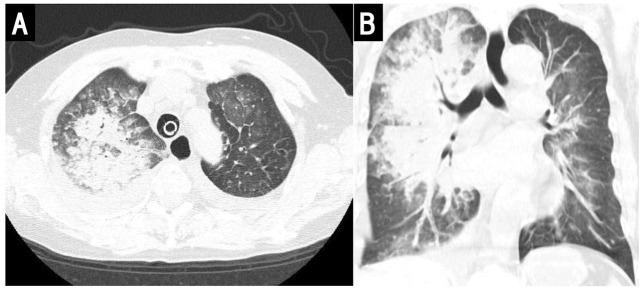 Unilateral Pulmonary Edema in Patients With Acute Mitral Regurgitation Caused by Chordal Rupture.