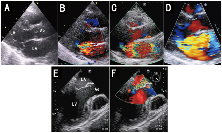 Unilateral Pulmonary Edema in Patients With Acute Mitral Regurgitation Caused by Chordal Rupture.