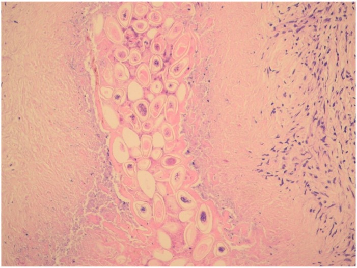 A Large Adnexal Tumor Caused by <i>Enterobius Vermicularis</i> Mimicking Malignancy.