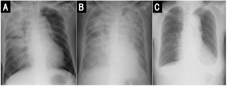 Unilateral Pulmonary Edema in Patients With Acute Mitral Regurgitation Caused by Chordal Rupture.