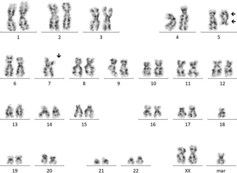 A treatment-refractory aggressive MDS-MLD with multiple highly complex chromosome 5 intrachromosomal rearrangements: a case report.