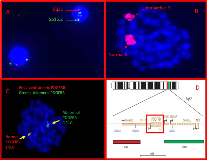 A treatment-refractory aggressive MDS-MLD with multiple highly complex chromosome 5 intrachromosomal rearrangements: a case report.